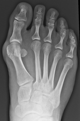 hallux vagus rontgenfoto